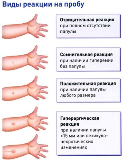 саркоидоз легких