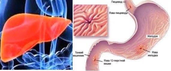 эндометриоз