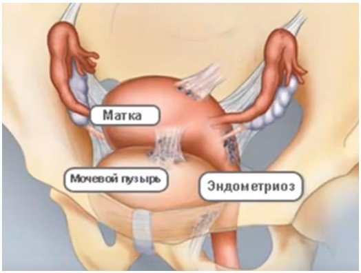 эндометриоз