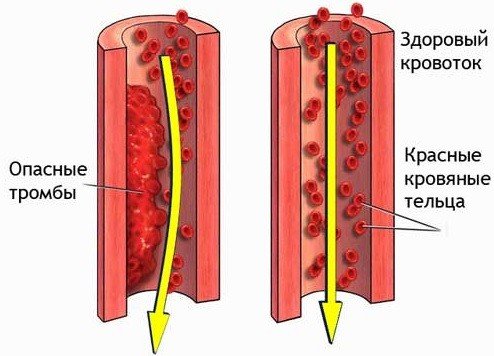 профилактика тромбоза