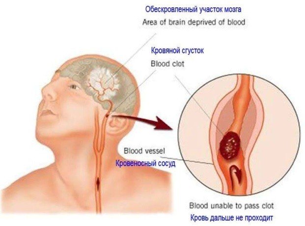 профилактика тромбоза