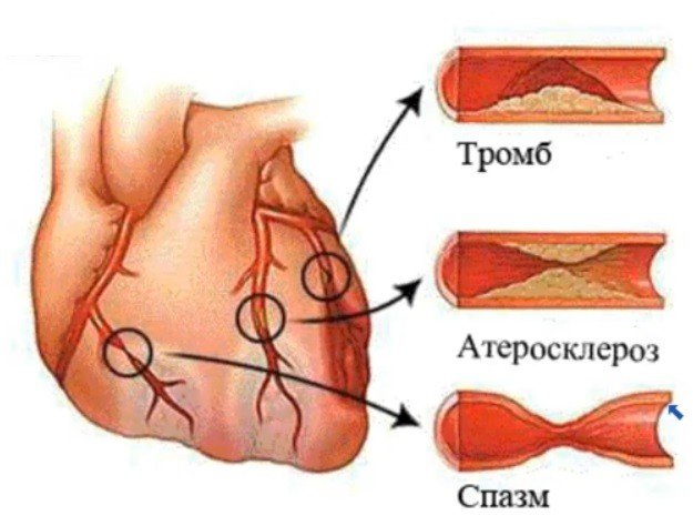 профилактика тромбоза
