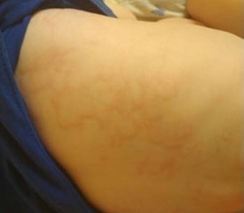 крапивница у ребенка