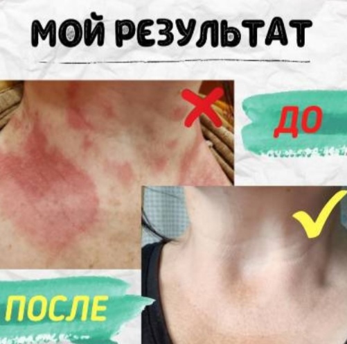 нейродермит